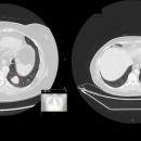 Благотворителен търг събра 27 000 лева за апарат за лечение на рак